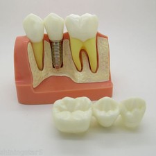 Apparecchiature dentali analisi impianti ponte corona dimostrazione denti modello insegnamento 