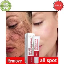 Melasma Treatment Dark Spots