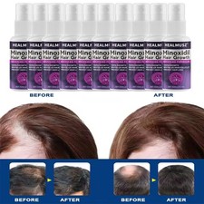 Minoxidil 2% per Donna Spray
