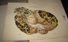 1845 fasc. 42 Cruveilhier Anatomia patologica corpo umano Fegato e Intestino ten