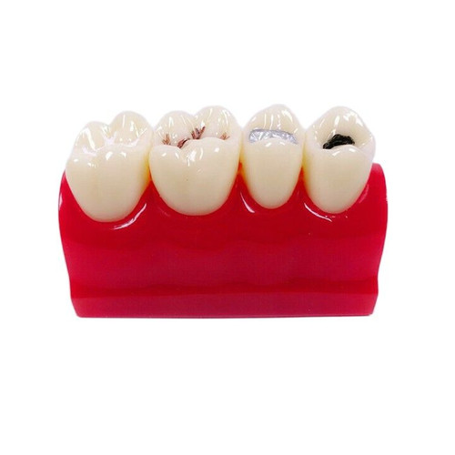 1pcs fessura - fessura,