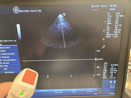 Sonda per ultrasuoni - sonda,