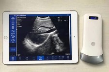 Sonda convessa ultrasuoni wireless 3,5-5mhz 80 elementi scanner macchina portatile