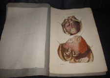 1839 fasc 31 Cruveilhier Anatomia patologica Malattie Cuore Midolla spinale Vene