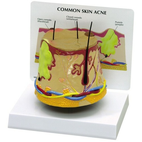 Acne cutanea modello - , anatomico