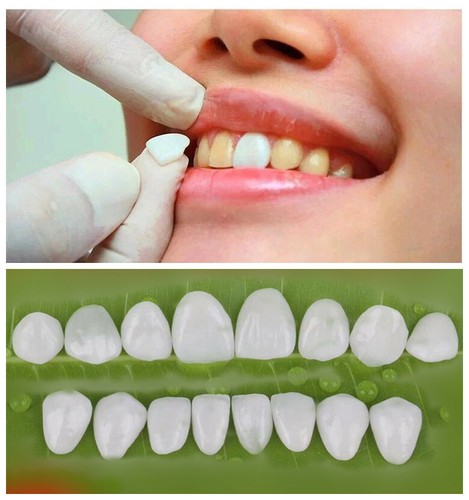 Impiallacciatura denti