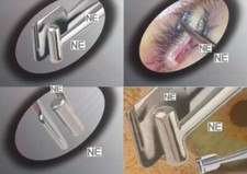 Pinzetta meibomian gland - ss,