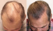 Minoxidil 2% Extra Strength