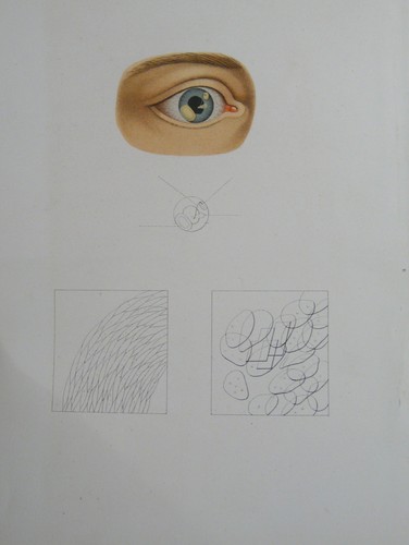 Epithélioma perlé iris - perlé, de