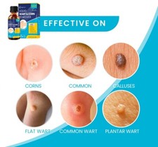 Quemar Verrugas Para Quitar