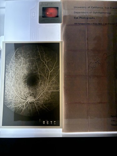 Ucsf oftalmologia retina - oftalmologia,