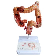 Insegnamento Modelhuman Intestino Anatomia Modello Visceral Lesion Modello Umana