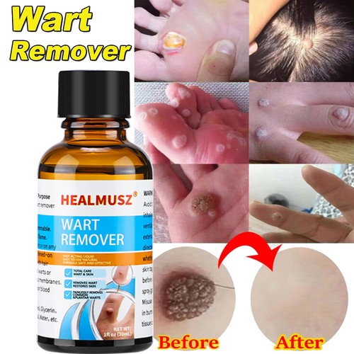 Healmusz rimuovi verruche - healmusz,