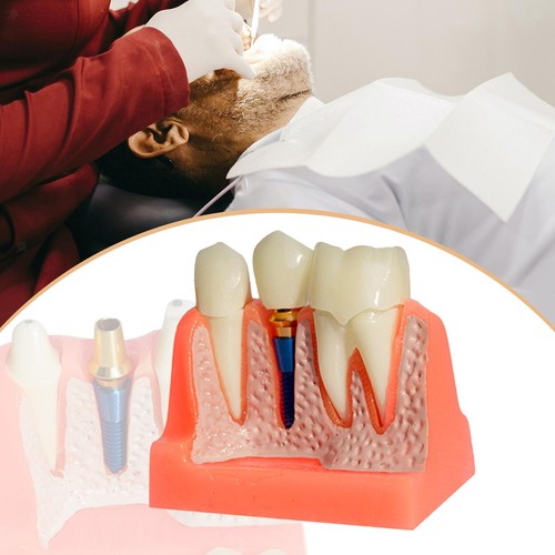 Modello impianto dentale - impianto,