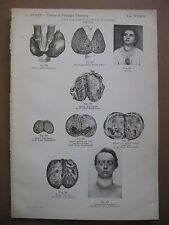 stampa antica old print DISPLASIE DELLE GLANDOLE ENDOCRINE TIROIDE GOZZO 1938