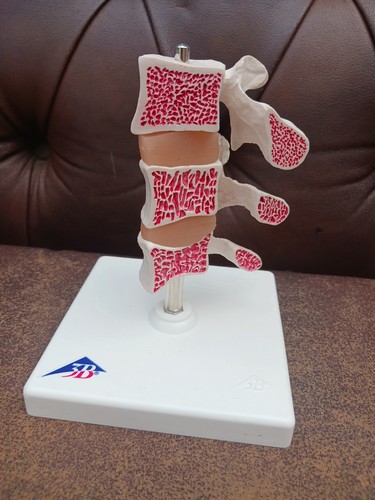 Modello osteoporosi anatomia