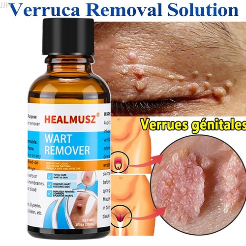 Healmusz rimuovi verruche - healmusz,