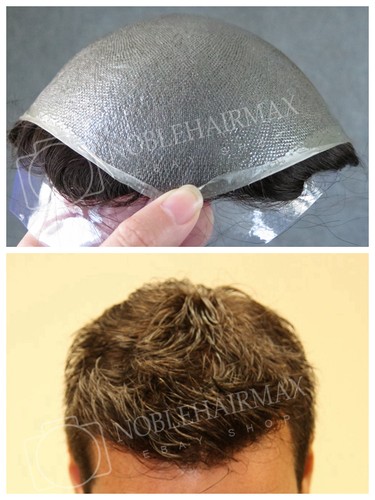 Capelli sostituzione pelle