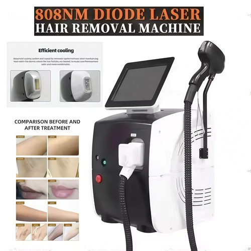 Macchina depilazione laser