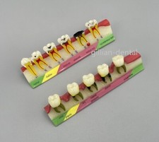 Carie parodontale dentale