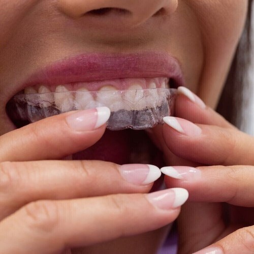 Bite dentale notturno - dentale,