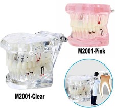 Modello Dentale Impianto Denti