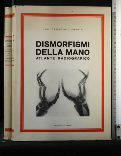 Dismorfismi della mano - dismorfismi,