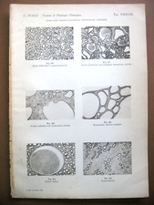 stampa antica old print DISPLASIE DELLE GLANDOLE ENDOCRINE TIROIDE GOZZO 1938