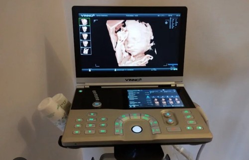 Portable ultrasound vinno - portable,