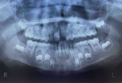Raggi reali testa dentale - raggi,