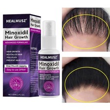 2% Minoxidil per Donna