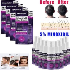 2% Minoxidil per Donna Spray