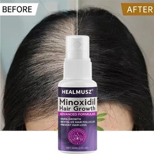 Minoxidil Donna 2% Crescita