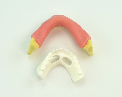Impianto mandibolare dentale