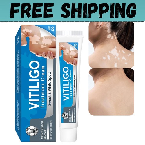 Trattamento vitiligine crema - trattamento, vitiligine,
