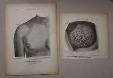 2 Stampe Anatomiche Vintage Antiquariato Medico Ghiandola Mammaria Donna Heroux