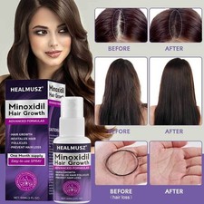 2% Minoxidil per Donna