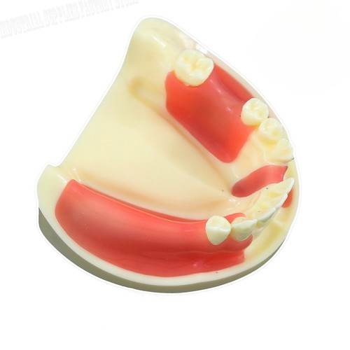 Impianto sutura dentista - impianto, di