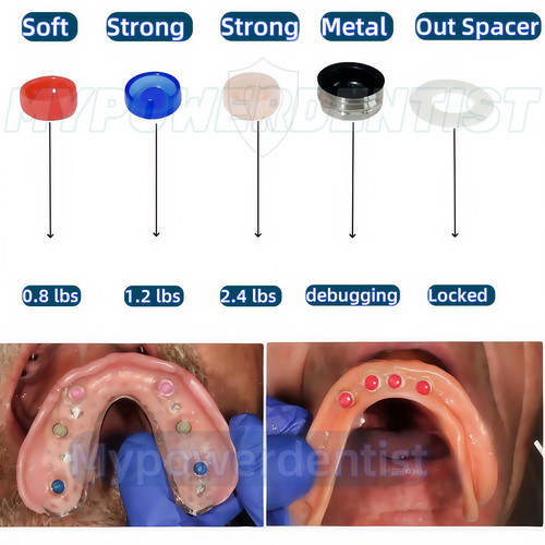 Localizzatore overdenture - localizzatore,