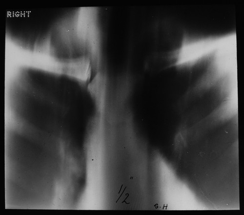 Xray human chest - xray,