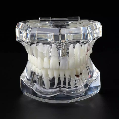 Modello impianto dentale - di,