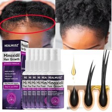 Minoxidil 2% Siero Crescita