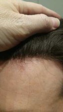 Protesi capelli uomo - , in