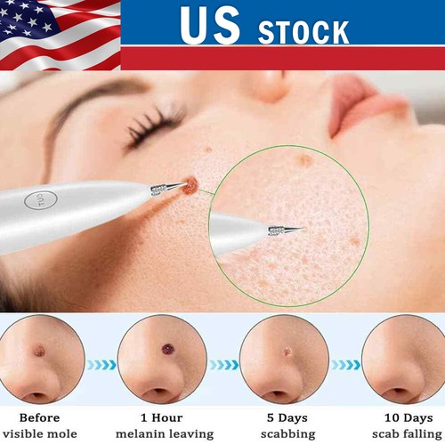 Penna plasma laser - al,