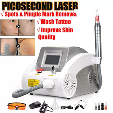 Macchina rimozione tatuaggi