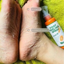 Foot Peeling Spray Callus