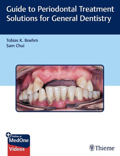 Guide periodontal treatment - guide,