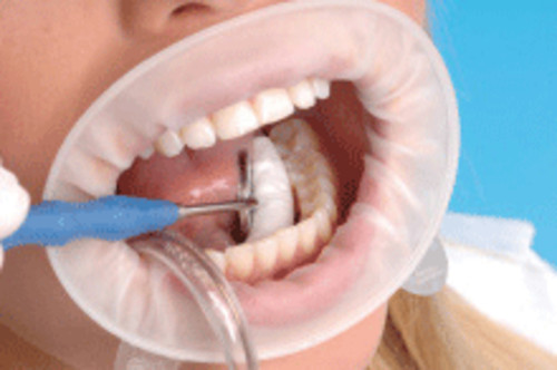 Ivoclar vivadent 590851 - ivoclar,
