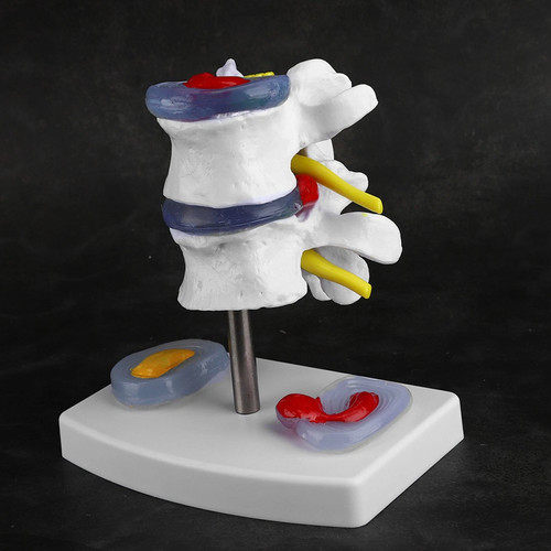 Modello dimostrativo ernia