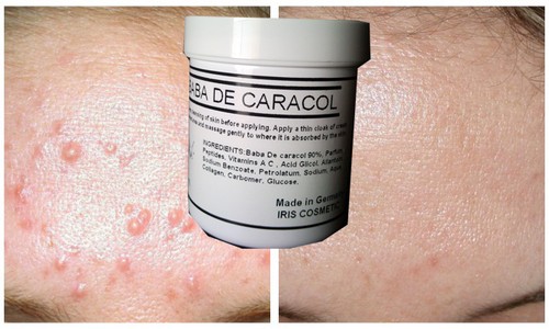 Acne macchie brufoli crema - macchie,